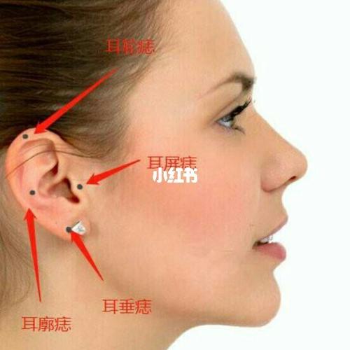 耳垂上有痣 耳垂上长痣代表什么